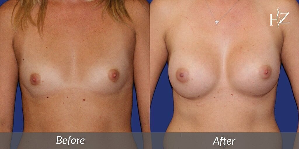 Breast Augmentation before and after 1