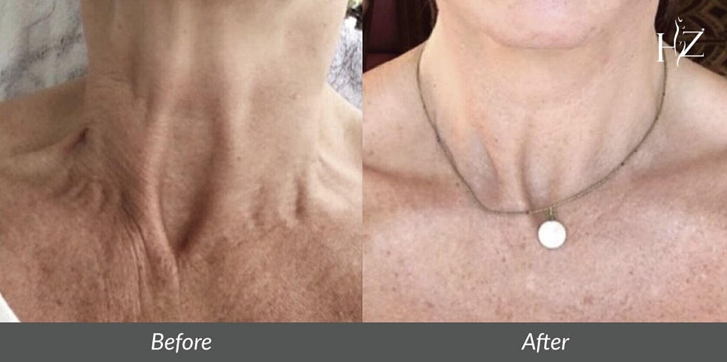 neck lift before and after 2