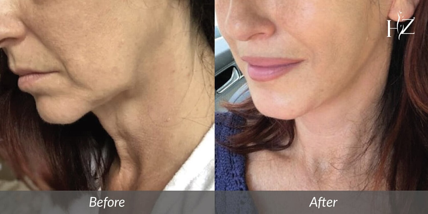 neck lift before and after 3
