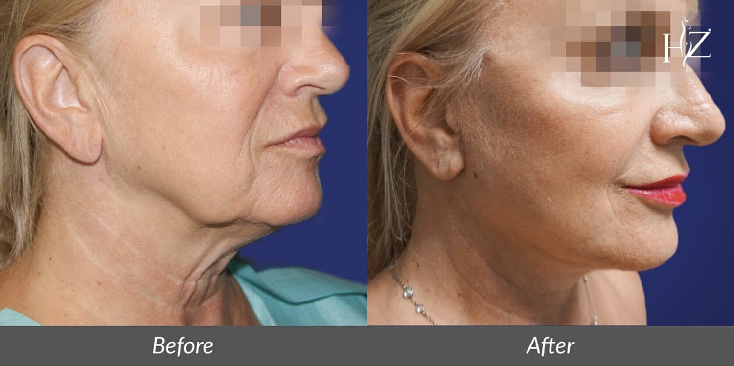 neck lift before and after 5