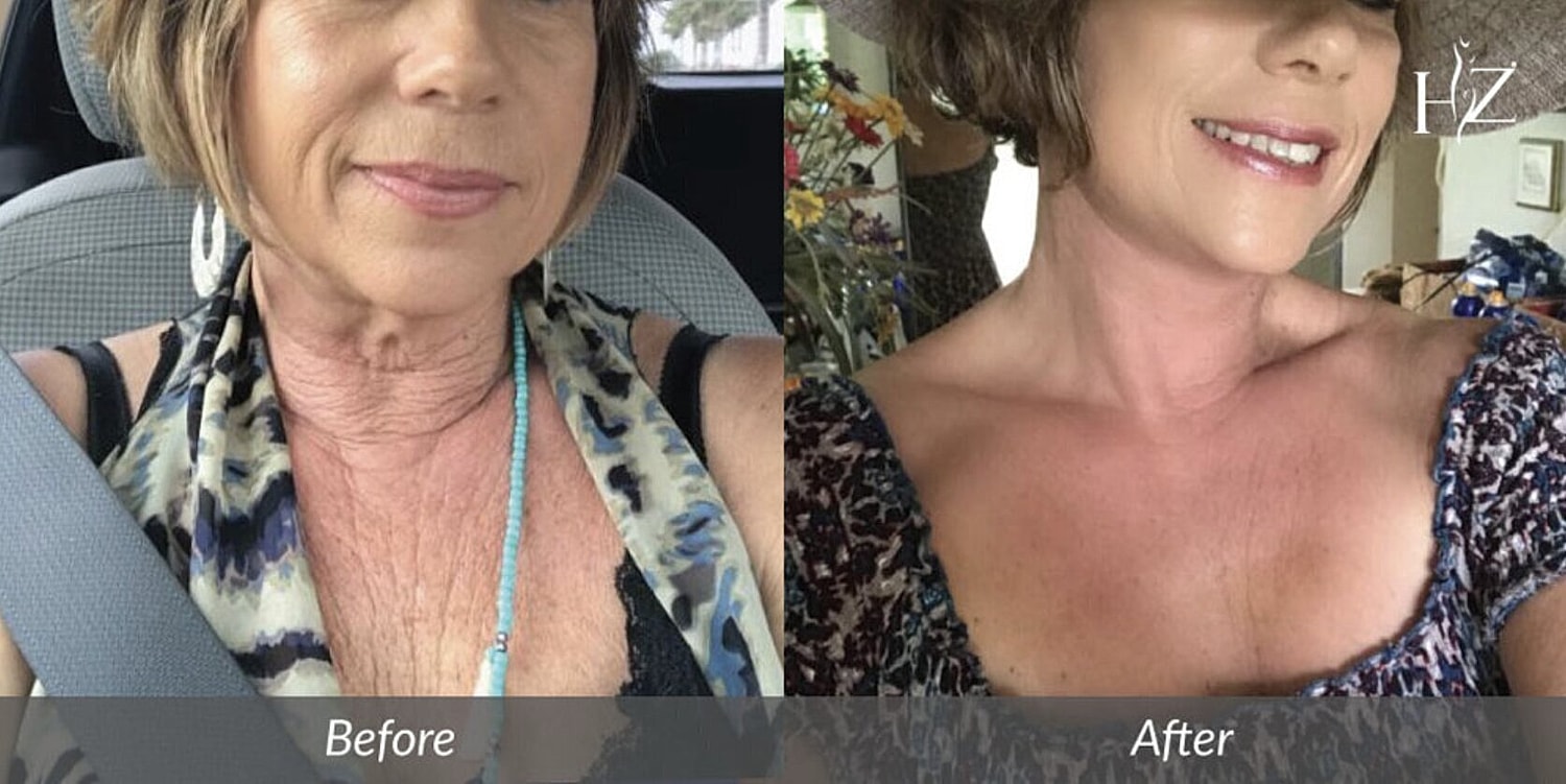 neck lift before and after 6