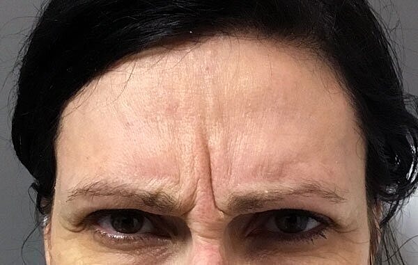 dysport patient 2 before pic
