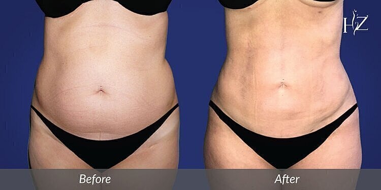 liposuction patient before and after 2