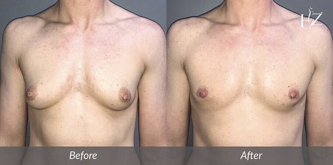 gynecomastia treatment patient before and after 1