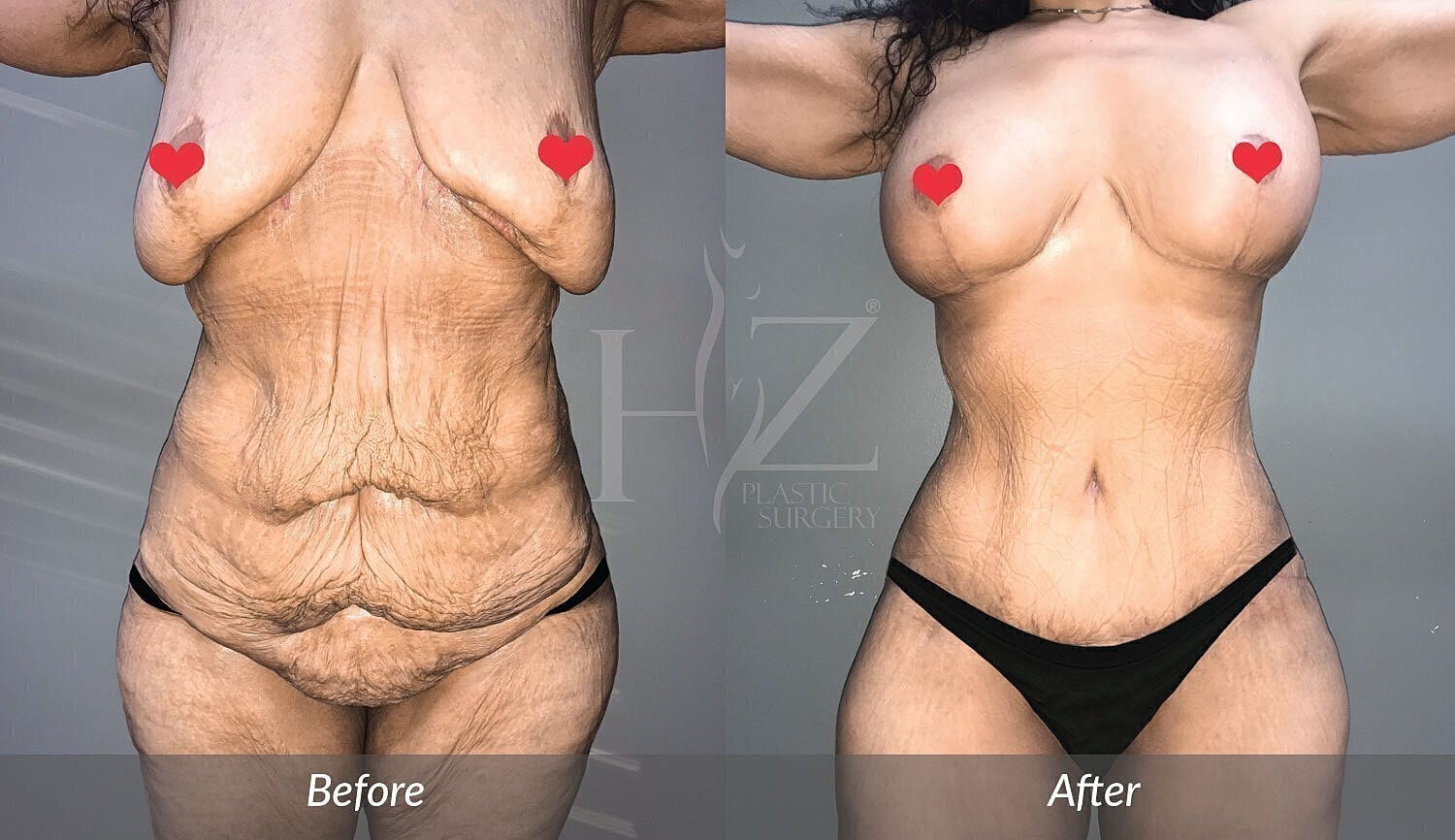 tummy tuck patient before and after 1