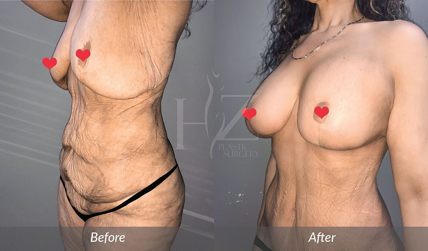 tummy tuck patient before and after 2