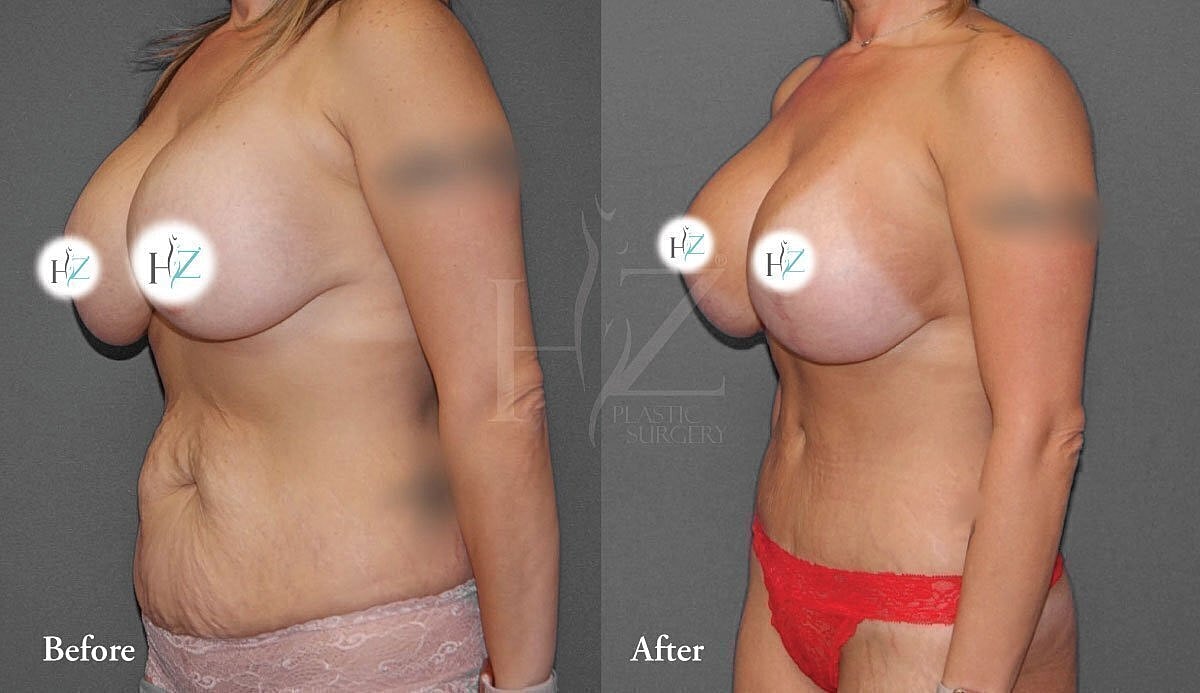 tummy tuck patient before and after 4