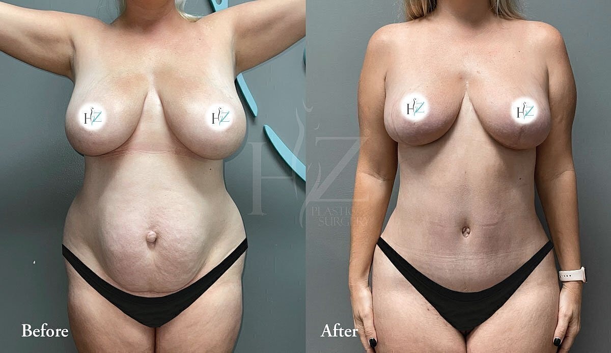 mommy makeover patient before and after 1