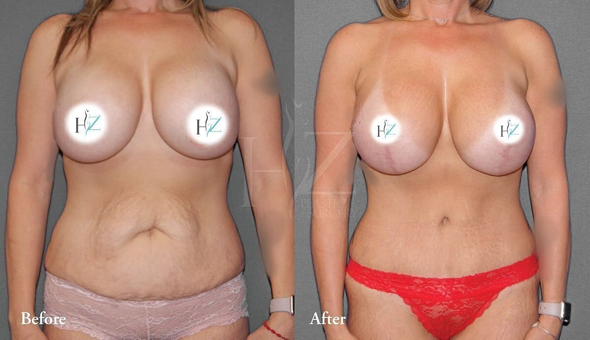 mommy makeover patient before and after 3