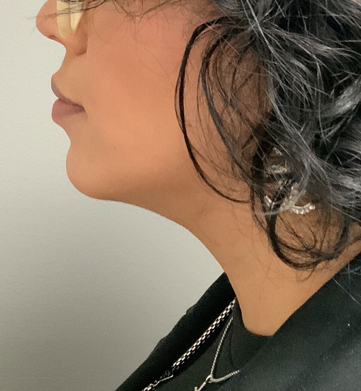 kybella patient after