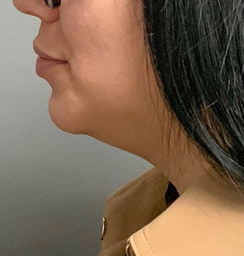 kybella patient before photo 1