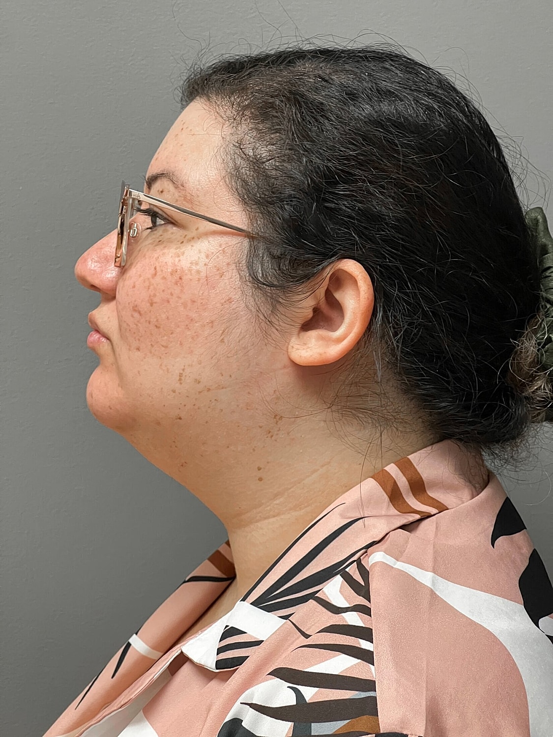 kybella patient before photo 2