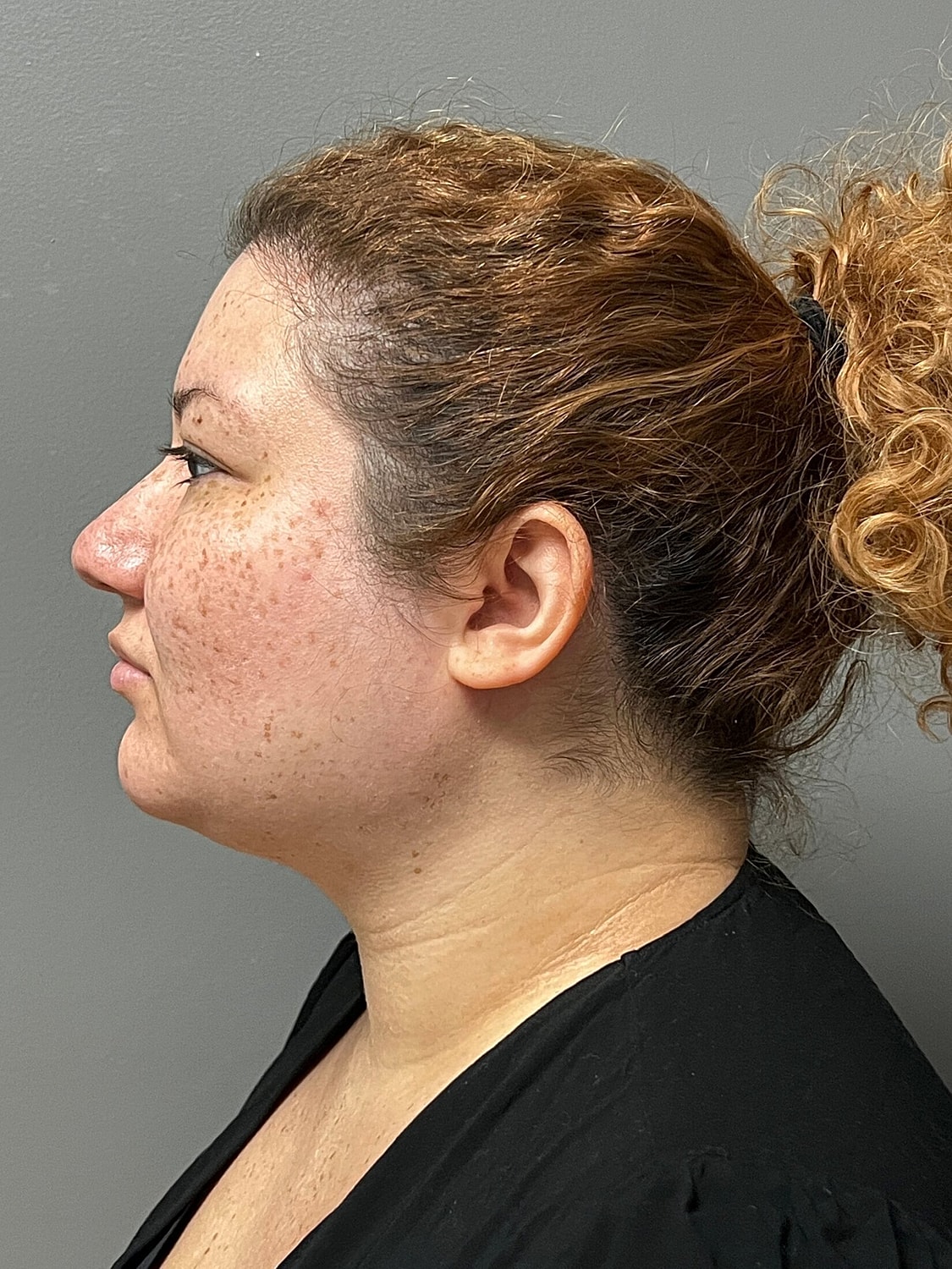 kybella patient after photo 2