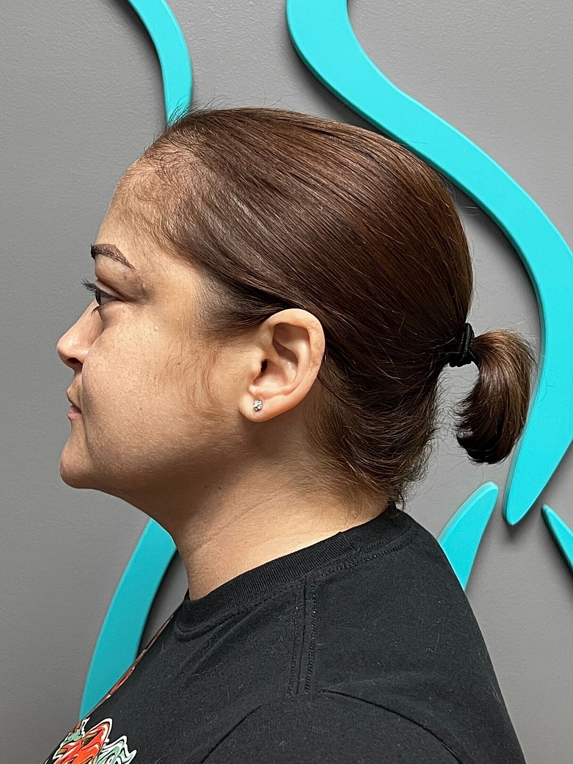 kybella patient after photo 3