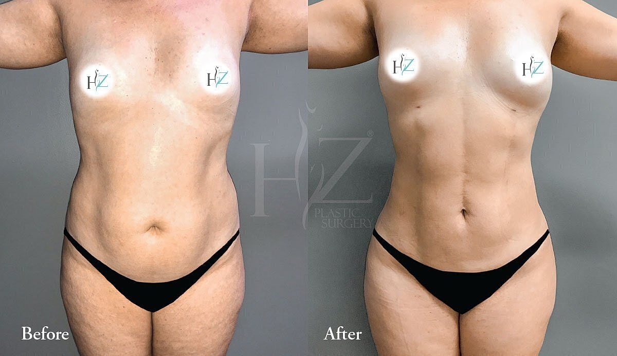 liposuction patient before and after 3