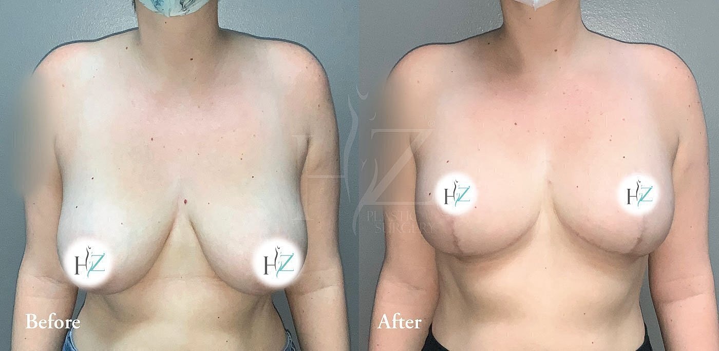 breast reduction patient before and after 1
