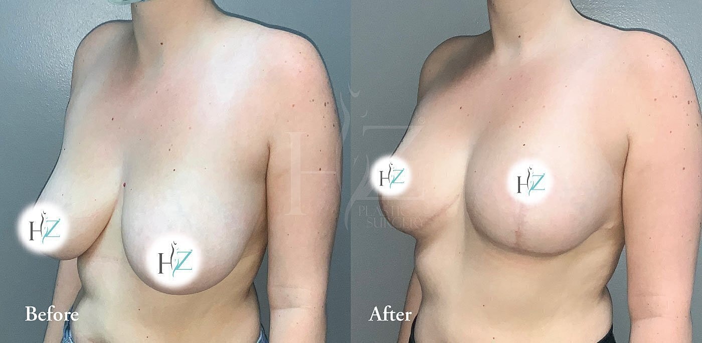 breast reduction patient before and after 2