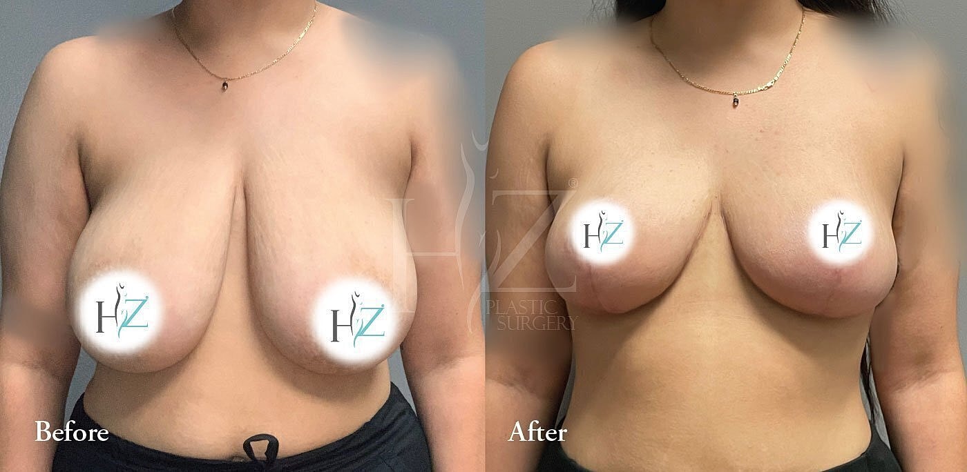 breast reduction patient before and after 3