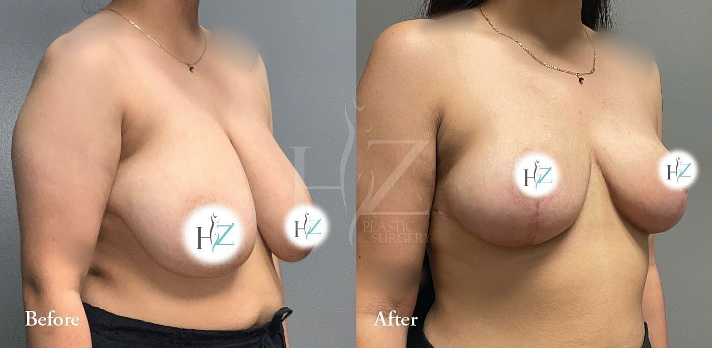 breast reduction patient before and after 4
