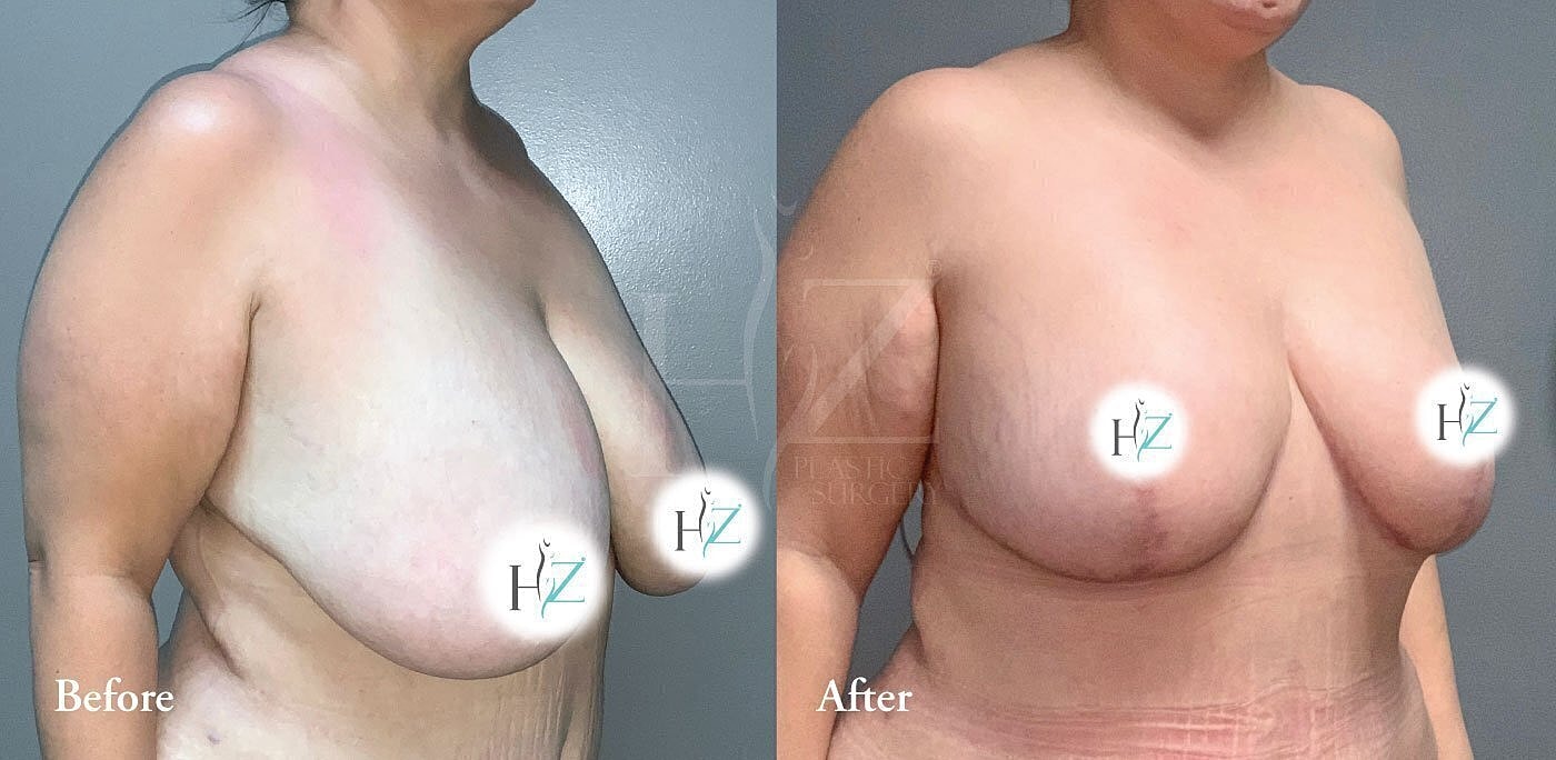 breast reduction patient before and after 6