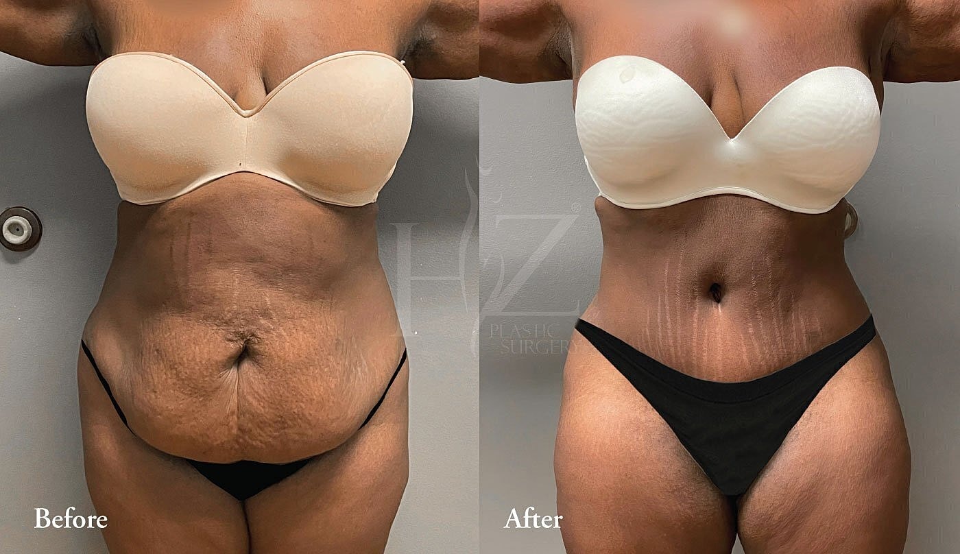 Body transformation before and after surgery.