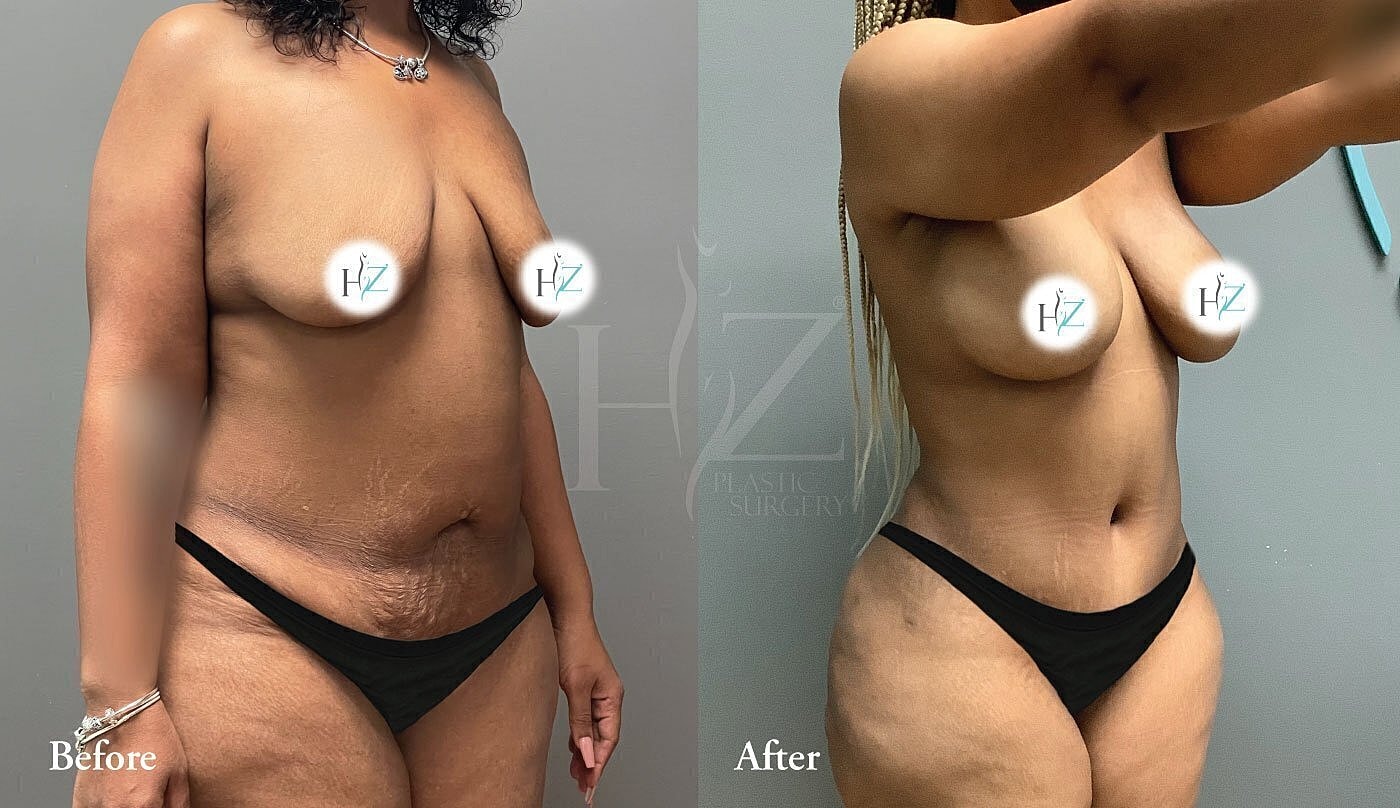 Before and after body transformation comparison.