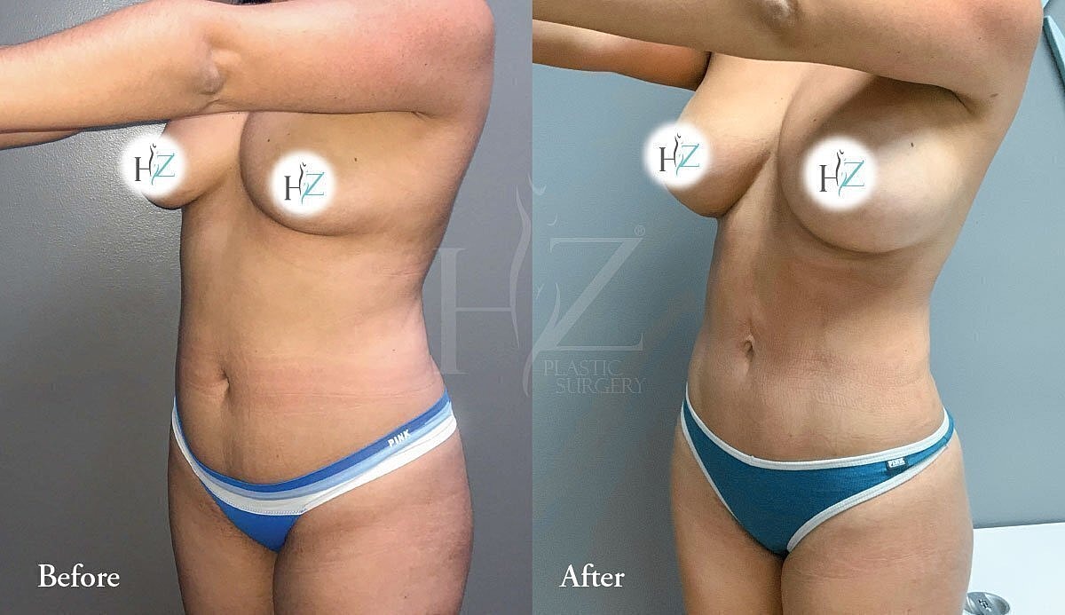 liposuction patient before and after 2