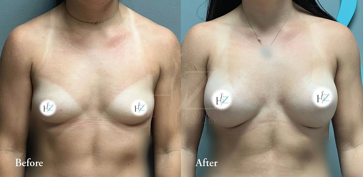 breast augmentation before and after 1