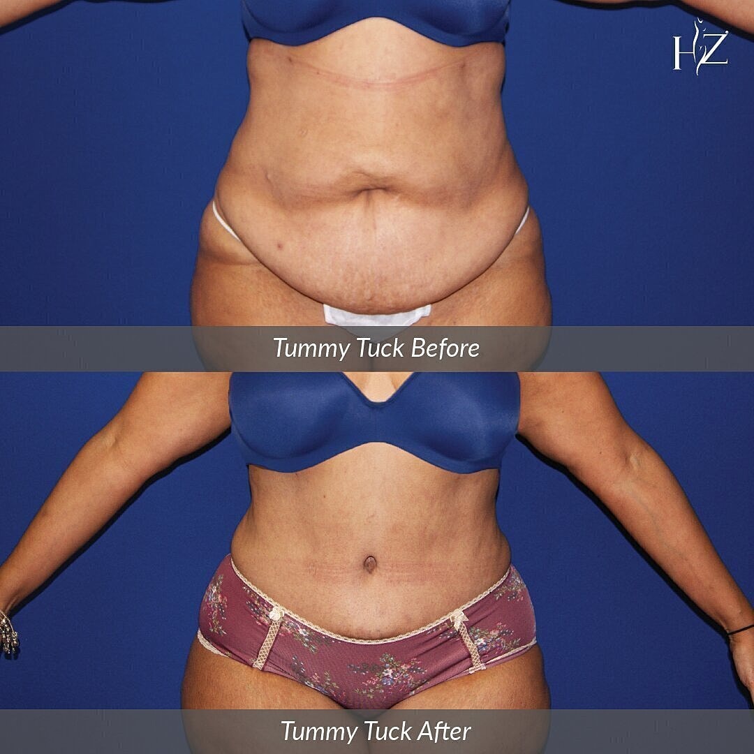 tummy tuck before and after, tummy tuck orlando, plastic surgeon orlando, plastic surgery before and afters