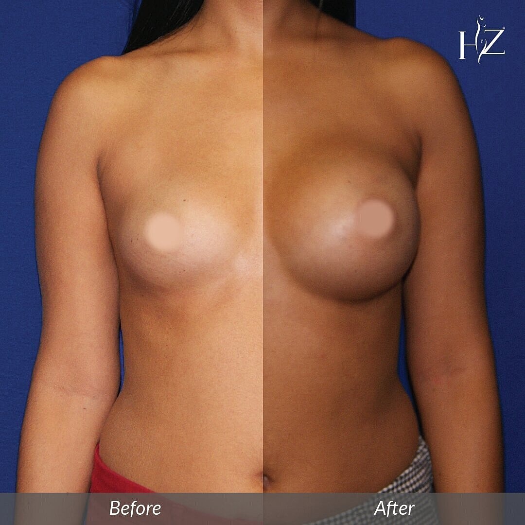 breast augmentation before and after, breast augmentation orlando, plastic surgeon orlando