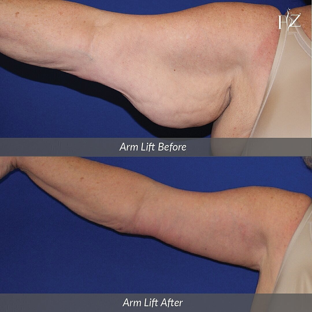 arm lift before and after, arm lift orlando, plastic surgeon orlando