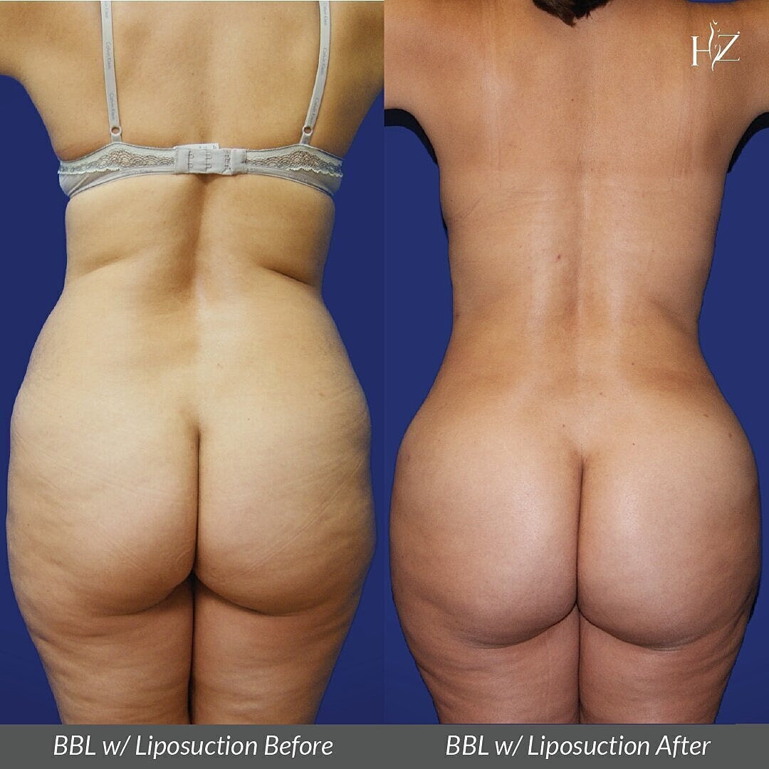 brazilian butt lift before and after, brazilian butt lift orlando, plastic surgeon orlando, plastic surgery before and afters