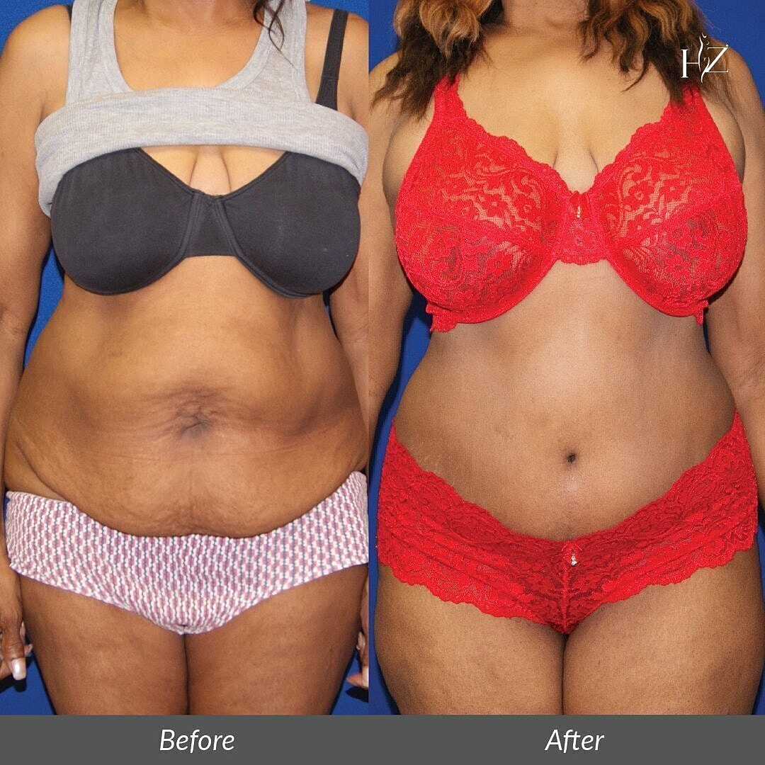 tummy tuck before and after, tummy tuck orlando, plastic surgeon orlando, plastic surgery before and afters