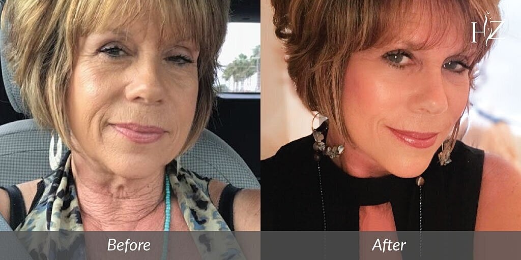 blepharoplasty patient before and after 1