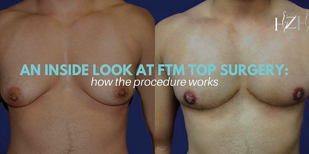 An Inside Look At FTM Top Surgery: How The Procedure Works