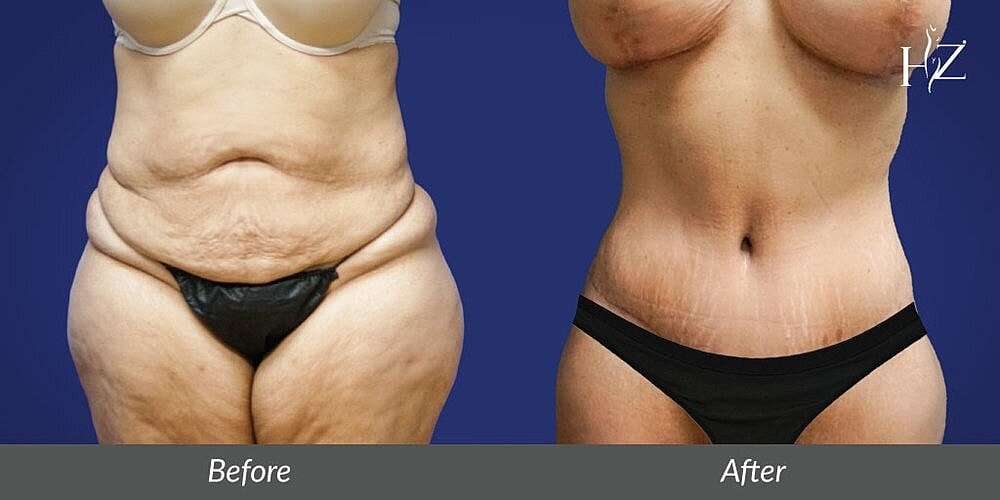 Can You Redo A Tummy Tuck?