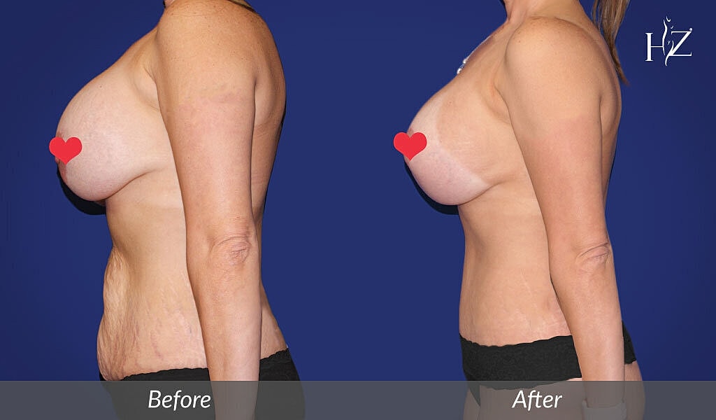 Everything You Need to Know About Mommy Makeover Surgery
