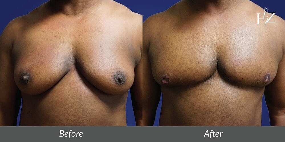 Female To Male Top Surgery 101: Everything You Need To Know