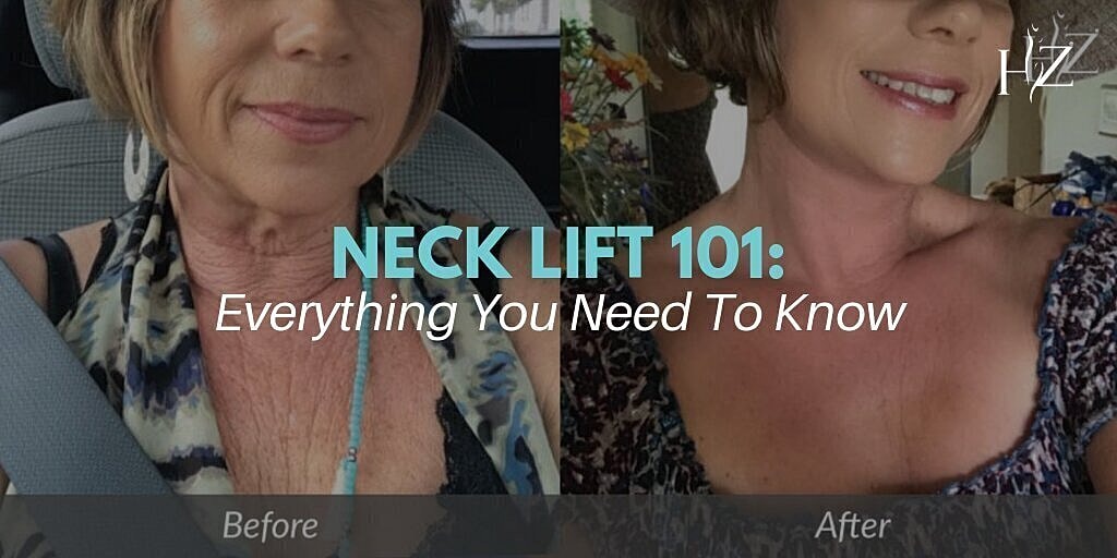 Neck Lift 101: Everything You Need To Know About The Procedure