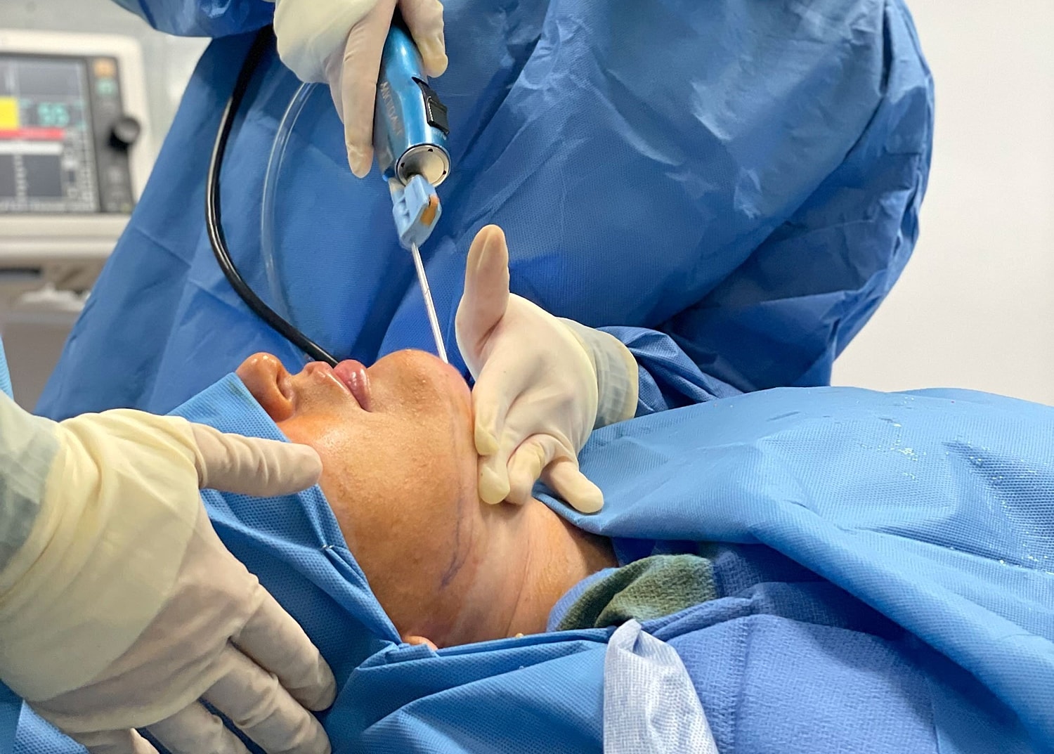 Plastic Surgery Edition: What Is Local Anesthesia?