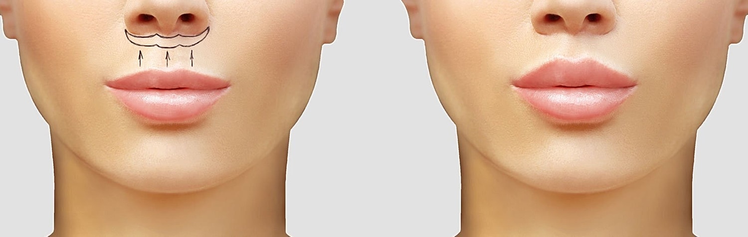 Upper Lip Lift VS Filler: When An Upper Lip Lift May Suit Your Goals