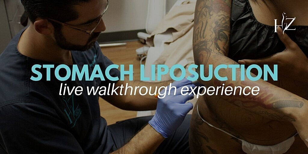 Stomach Liposuction Live Walkthrough Experience