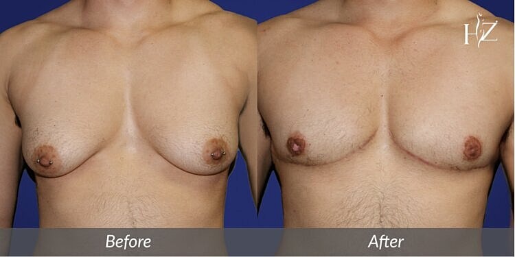 Top Surgery: Which Incision Is Right For Me?