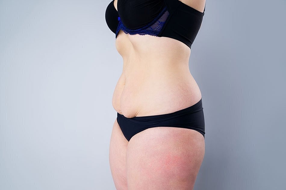 Tummy Tuck Or Liposuction: How Do I Know Which Is Right For Me?