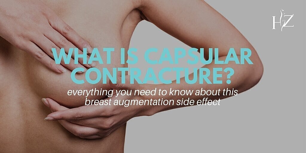 What Is Capsular Contracture? Everything You Need To Know About This Breast Augmentation Side Effect