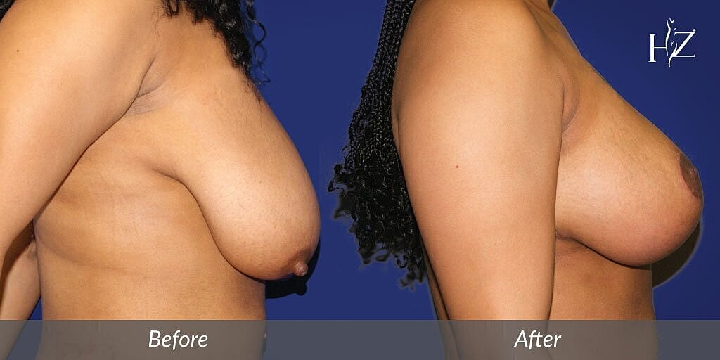 Before and after breast augmentation comparison.
