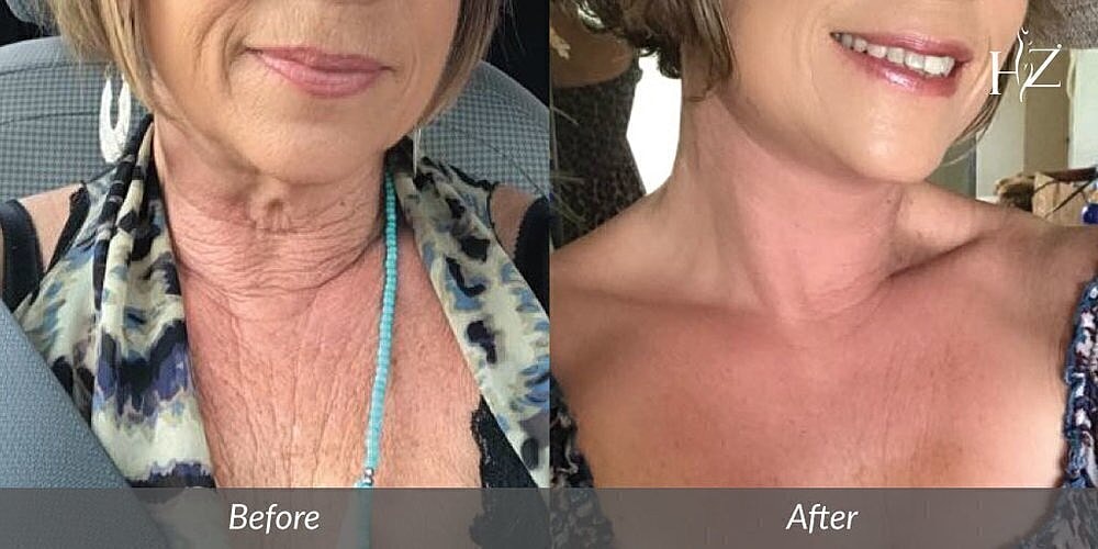 Before and after skin treatment comparison.