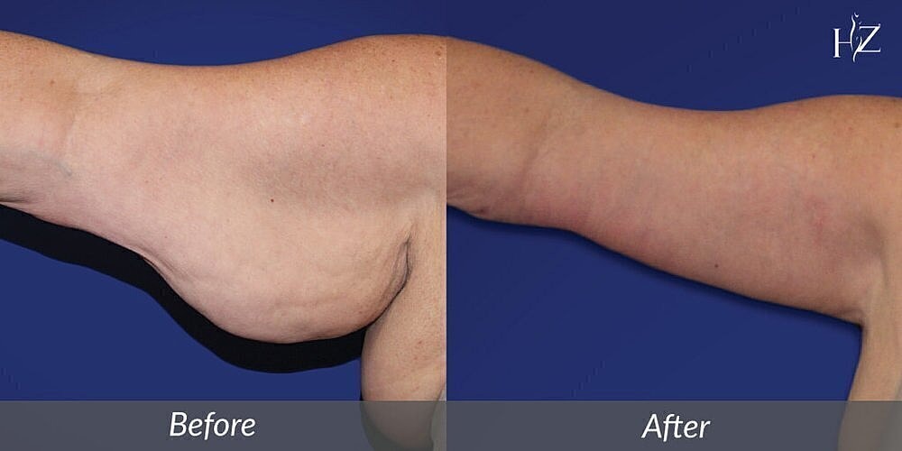 Before and after arm transformation image.