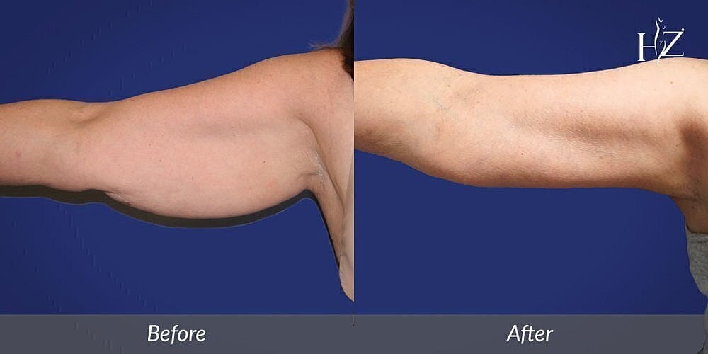 Arm transformation before and after treatment.