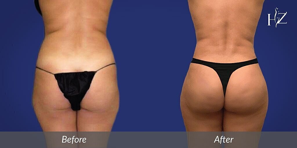 Body transformation before and after comparison.